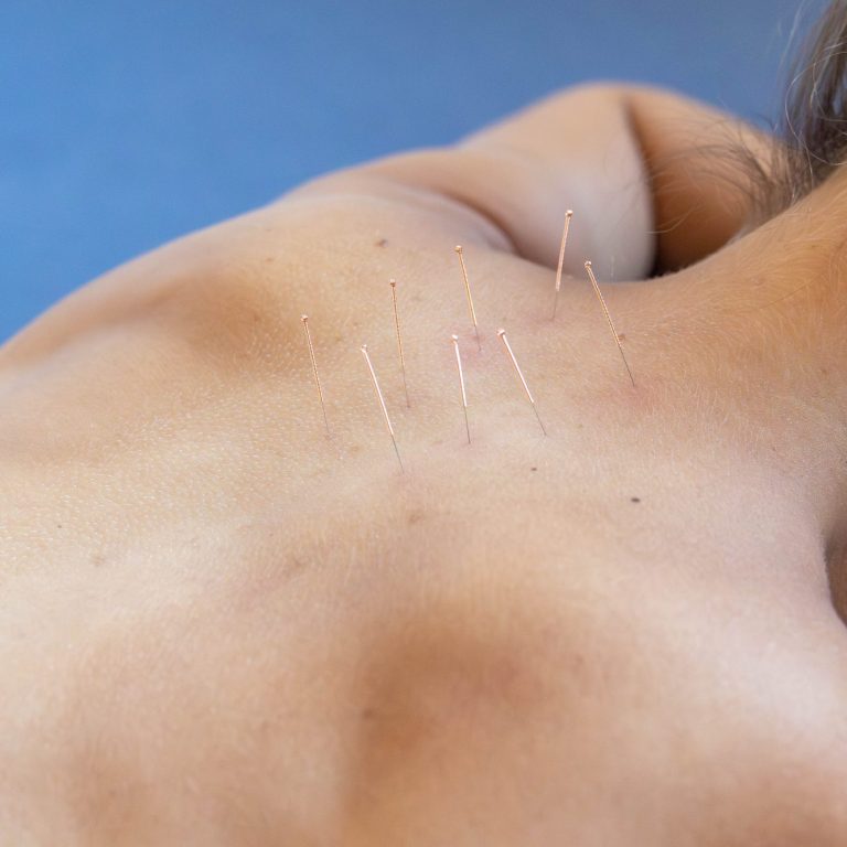 Akupunktur Akupunktur-Nadeln sind auf dem Rücken einer auf dem Bauch liegenden Patientin platziert.