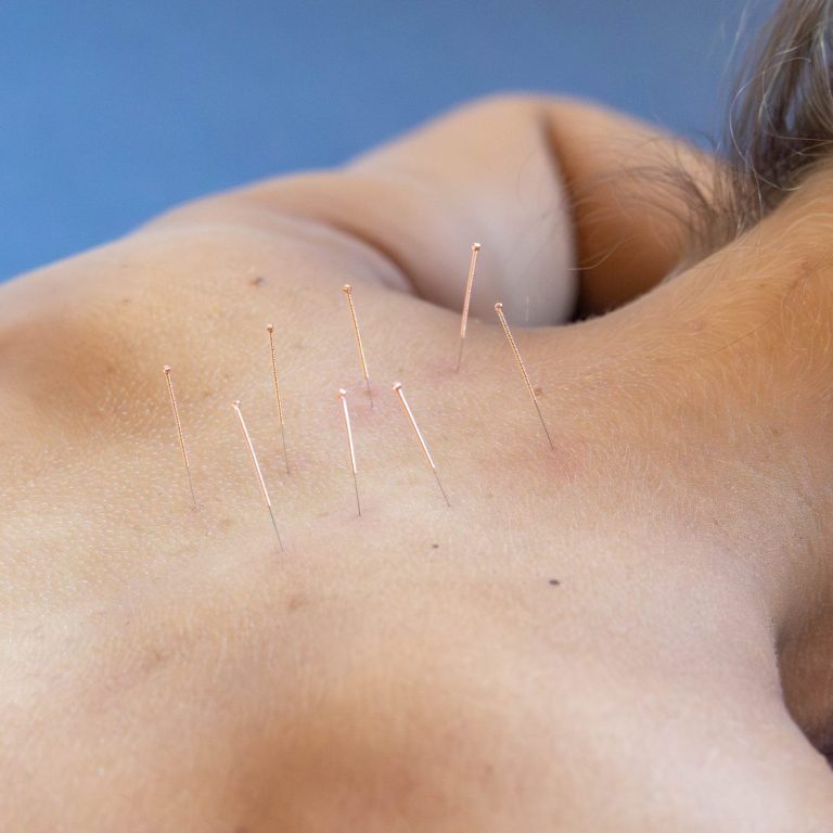 TCM / Triggerpunkt Akupunktur Akupunktur TCM Behandlung muskuloskelettaler Beschwerden orthopädisch