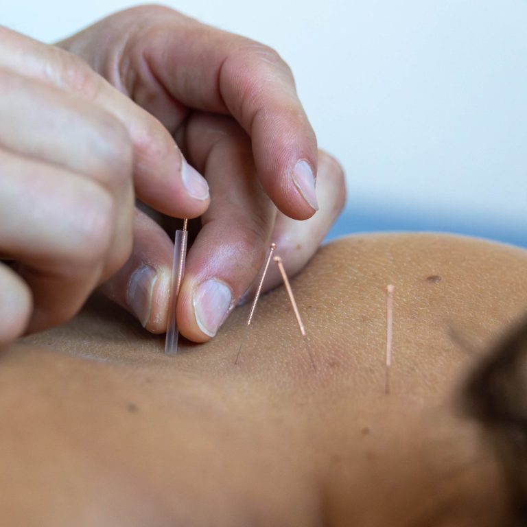 Abbildung einer orthopädischen Akupunkturbehandlung.